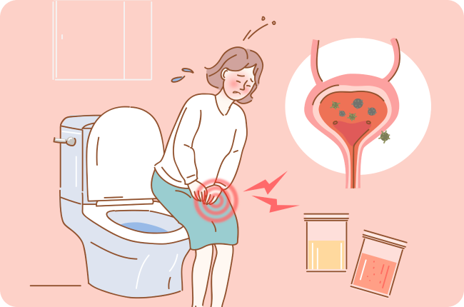 방광 내 결석